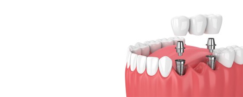 A dental implant is a surgical process, and in this process, a metal frame is being inserted inside your jawbone and then screws it up. This metal framework as the root of the artificial tooth and also supports adjacent teeth. Visit us for affordable dental implant services in Perris, CA. Visit us: https://nuevoperrisdental.com/services/dental-implants-perris-ca/