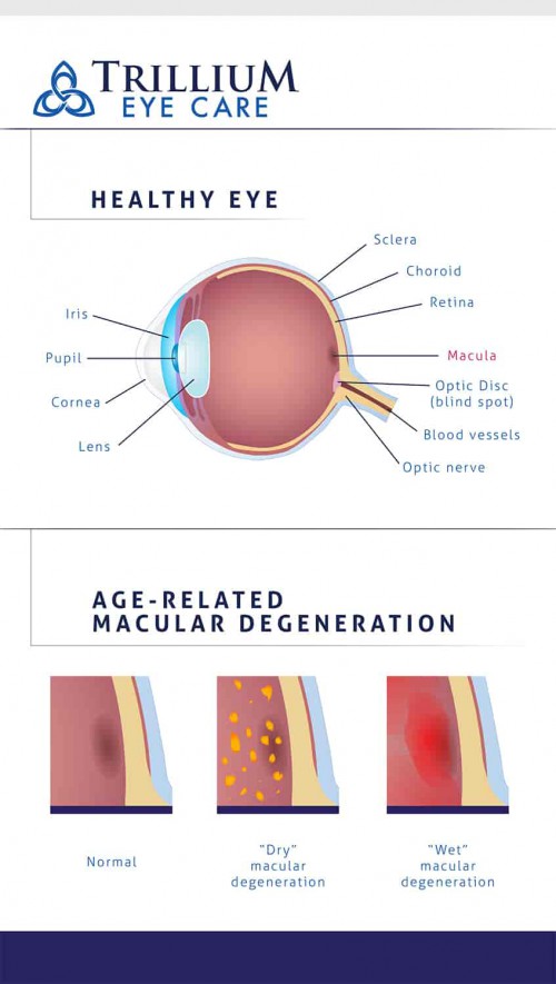 In this infographic, we share the different types of age-related macular degeneration.

Source: https://bit.ly/2WivsKS

It is highly recommended to consult with your optometrist at least once a year for a comprehensive eye exam because early stages of age-related macular degeneration may have zero to little symptoms.

Dr. Alexandra Vorobeva, a managing optometrist of Trillium Eye Care, offers comprehensive eye exam in Jacksonville, FL.

You may visit her website at www.trilliumeyecare.com